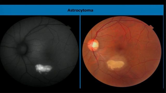 AIOC2018 - IC208 - Autofluorescence techniques: dilemmas - Dr.Shorya Vardhan Azad смотреть онлайн