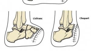 протез стопы