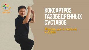 Коксартроз тазобедренных суставов! Жизнь до и после У-СИН