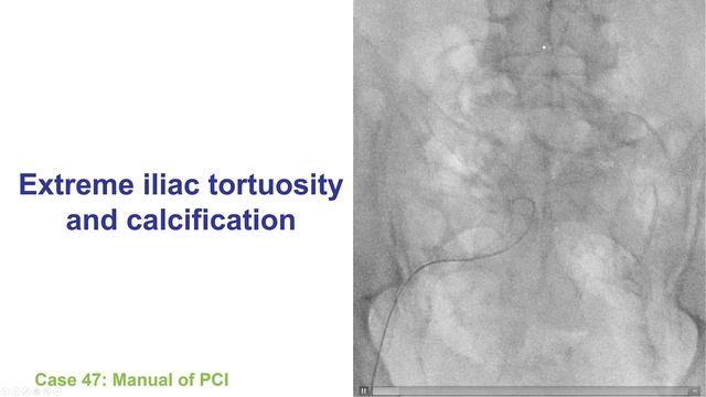 5.5 Manual of PCI - Resistance to guidewire/catheter advancement via femoral access смотреть онлайн