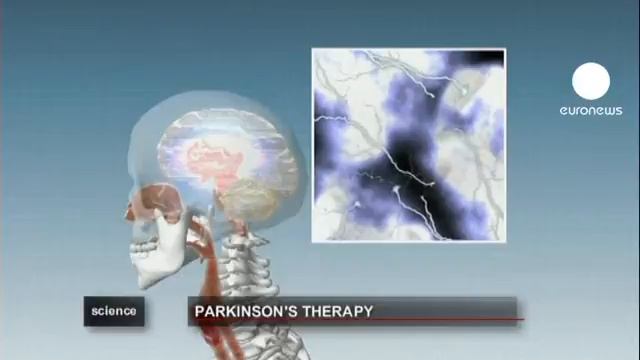 euronews наука - Генна терапія для хворих на паркінсонізм смотреть онлайн