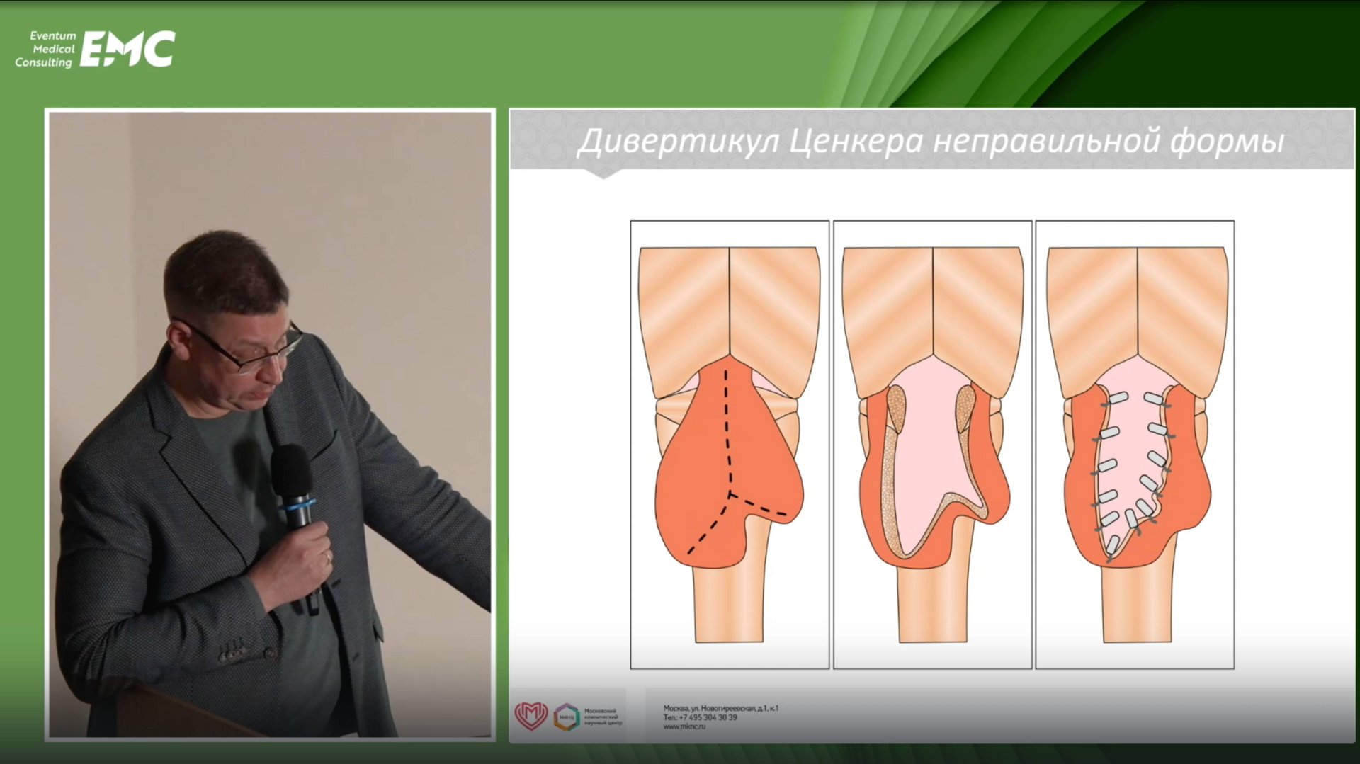 5 Шишин КВ ПятаковаАВ Особенности эндоскопических вмешательств при нестандартном дивертикуле Ценкера