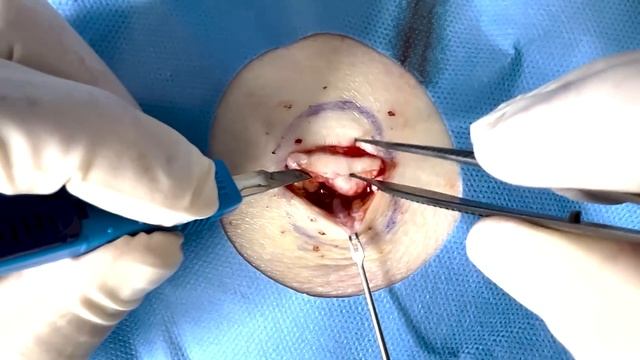 Ball filled with Cheese - Cyst Removal | CONTOUR DERMATOLOGY смотреть онлайн