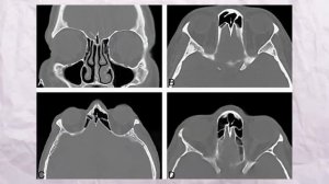 Как избавиться от заложенности носа?