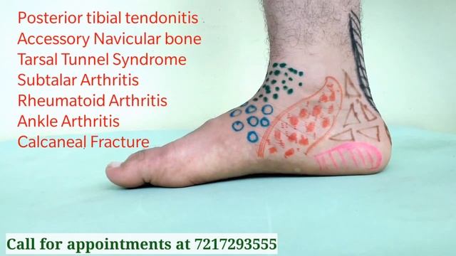 टखने, ऐडी और तलवे दर्द: कारण | Causes of Ankle and Heel Pain | Dr. Vivek Gaur (PT) смотреть онлайн