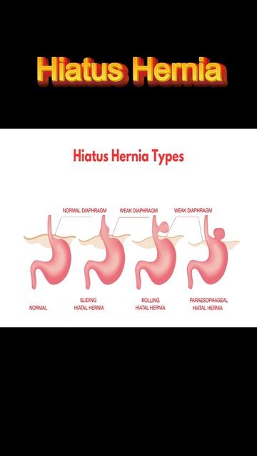 Investigating Hiatus Hernia In Hindi | हायटस हर्निया की जांच In Hindi | Dr Brijesh Dube