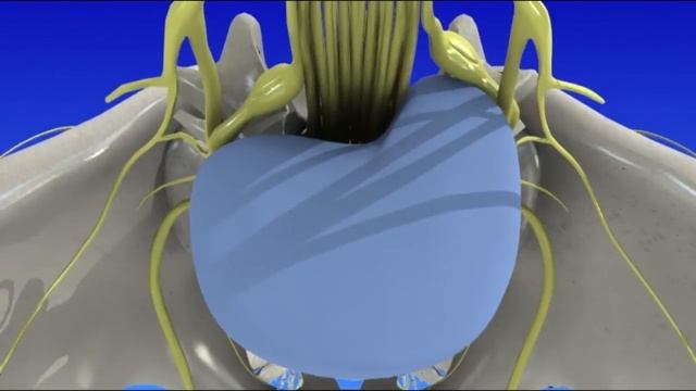 Spinal Stenosis смотреть онлайн