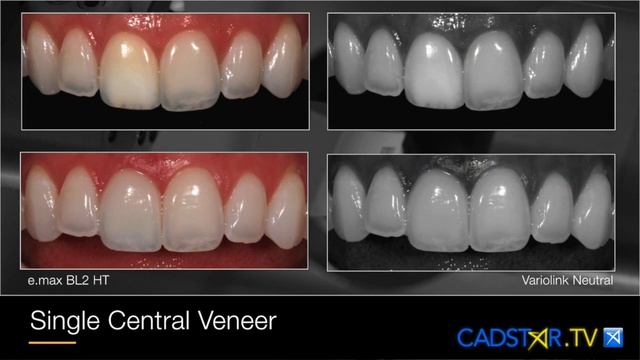 Variolink Esthetic Try in Paste and Resin Cement смотреть онлайн
