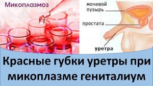 Красные губки уретры при микоплазме гениталиум