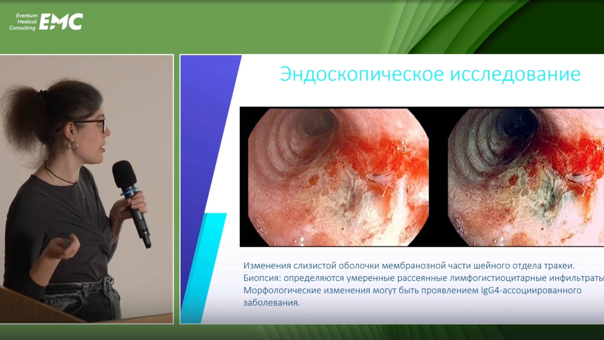 2 Симонова МС Русаков МА Случай лечения рубцового стеноза ЛГБ у пациентки с IgG4-ассоц заболеванием