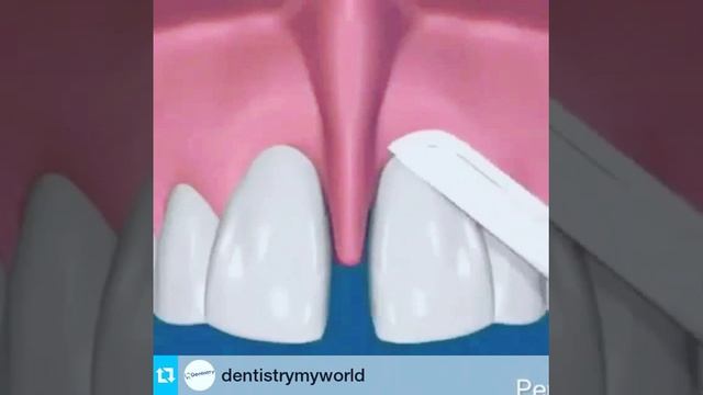 Diastema por inserción baja de frenillo смотреть онлайн
