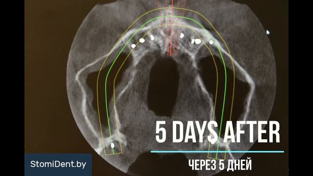 Basal immidiate load dental implantation in Belarus (Minsk) смотреть онлайн