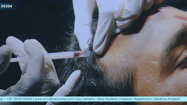 PRP (Platelet-rich Plasma ) Procedure | ACME Hair World | #hairfall #hairtransformation смотреть онлайн