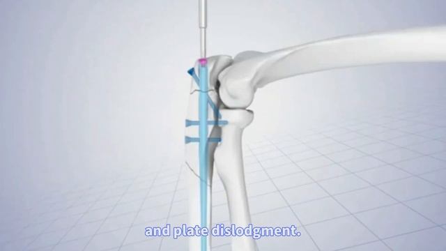 Intramedullary Nail: An Important Tool for Improving Fracture Treatment---HMEonline Channel смотреть онлайн