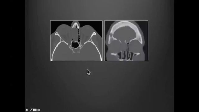Skull Base Imaging ASHNR20 смотреть онлайн