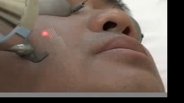 Derm Refresh - Profractional Laser Resurfacing смотреть онлайн