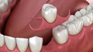 Протезирование зубов