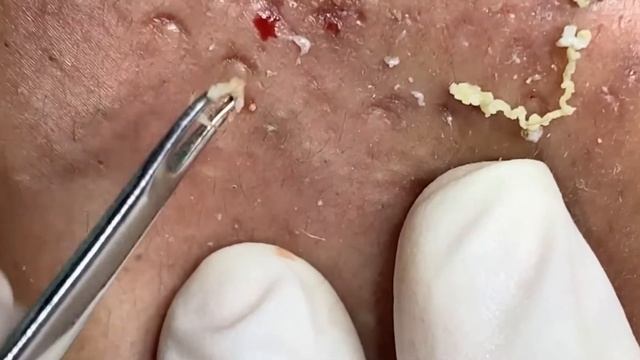 Deep-seated acne, blackheads, EP2, right cheek смотреть онлайн