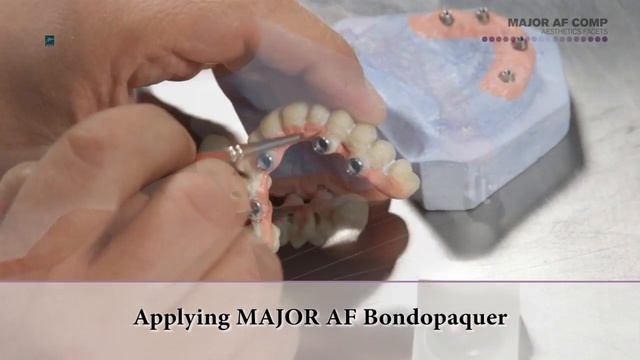 AF COMP – Implant Supported Prosthesis on titanium abutments and fiberglass frame смотреть онлайн
