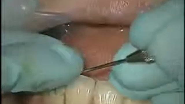 Henry Schein UK - Pulpdent Embrace Resin Cement Clinical Application смотреть онлайн