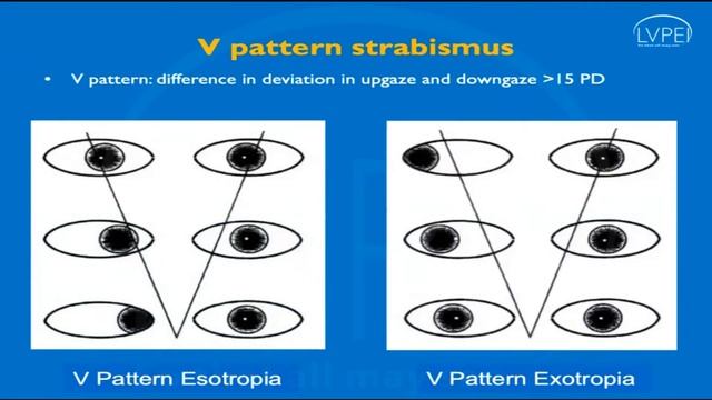 A2R: # Season 1: 37 (Pattern Strabismus and a chin down posture) смотреть онлайн