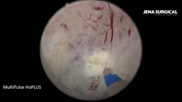 HoLEP. Лазерная энуклеация аденомы объемом 60 см³.Дивертикулез МП.MultiPulse HoPLUS (JENA Surgical)