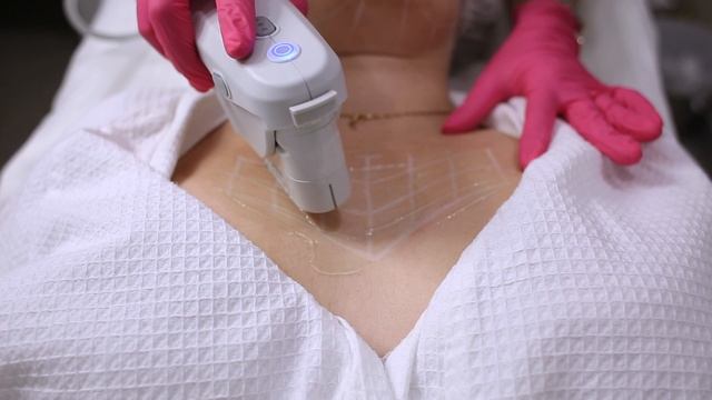 Ulthera SMAS лифтинг смотреть онлайн