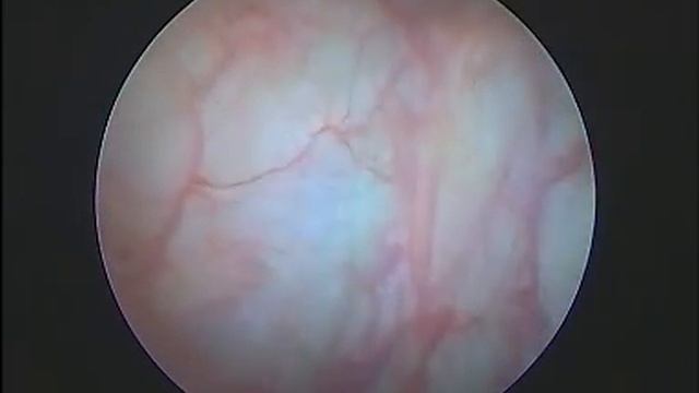 Intersticial Cystitis cystoscopy смотреть онлайн