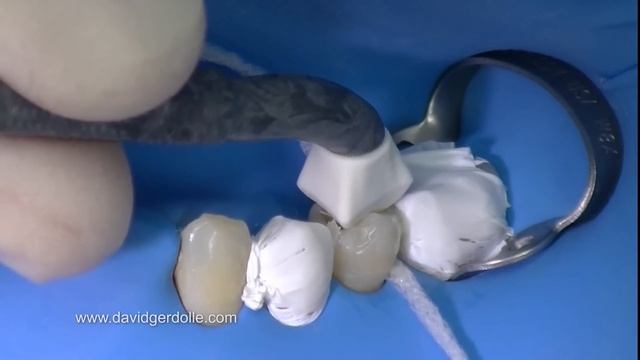 Onlay cementation смотреть онлайн