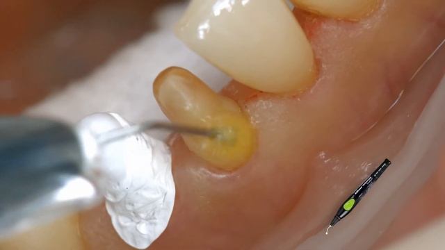 Variolink Esthetic DC Monobond Etch&Prime смотреть онлайн