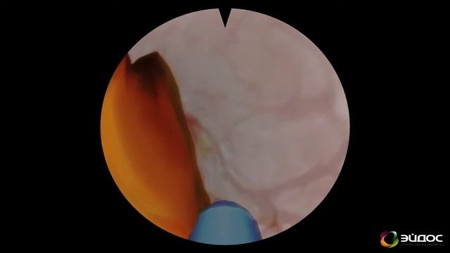 Эйдос—Медицина. Эндоурология смотреть онлайн