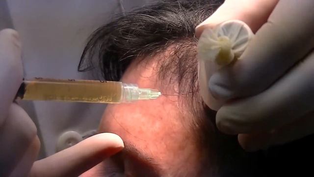 Injecting Platelet rich Plasma PRP for the Treatment of Hair loss смотреть онлайн