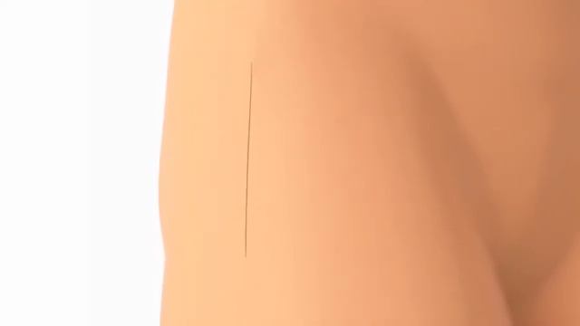 Hip Arthroplasty