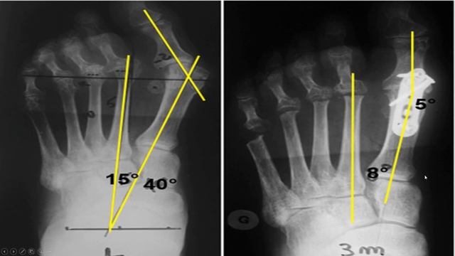Big Toe Joint Foot (MTJ) Fusion **Is It Worth It?** смотреть онлайн