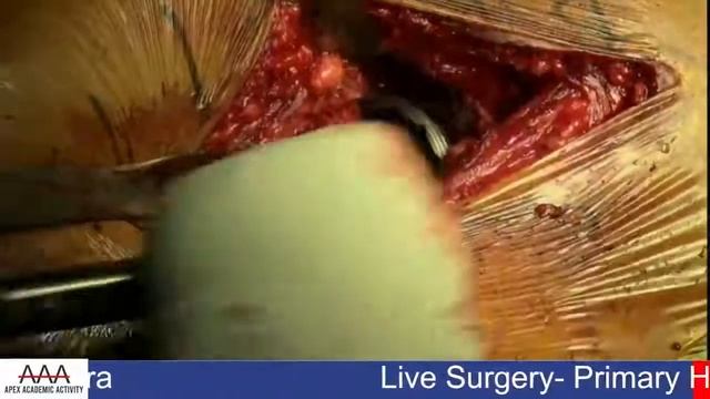 DIRECT ANTERIOR APPROACH TOTAL HIP REPLACEMENT (DAA THR) - Dr Rohit Luthra - LIVE SURGERY WORKSHOP смотреть онлайн