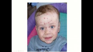 Ветрянка у детей: симптомы, лечение и уход