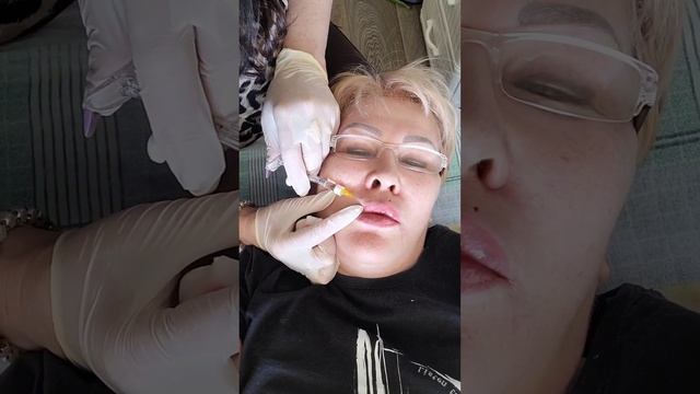 Контурная пластика лица.Лицо под ключ.Косметолог Ирина Смирнова. смотреть онлайн