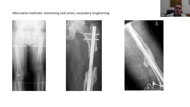 Ukraine Lower Limb Webinar Series - Management of Bone defects смотреть онлайн