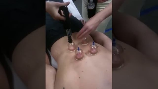 Cupping Demonstration for Weight loss смотреть онлайн