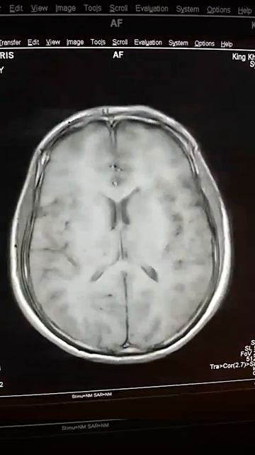 MRI brain infection смотреть онлайн