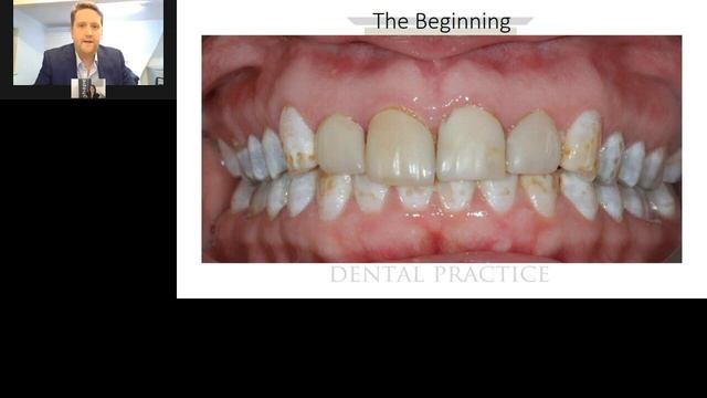 How single-visit dentistry changed my practice - live webinar with Dr. Doug Watt смотреть онлайн