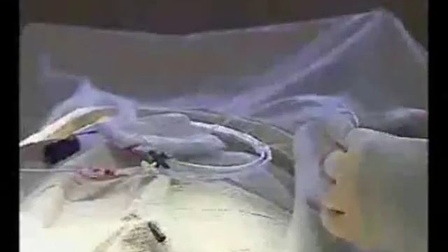 Катетеризация подключичной вены смотреть онлайн