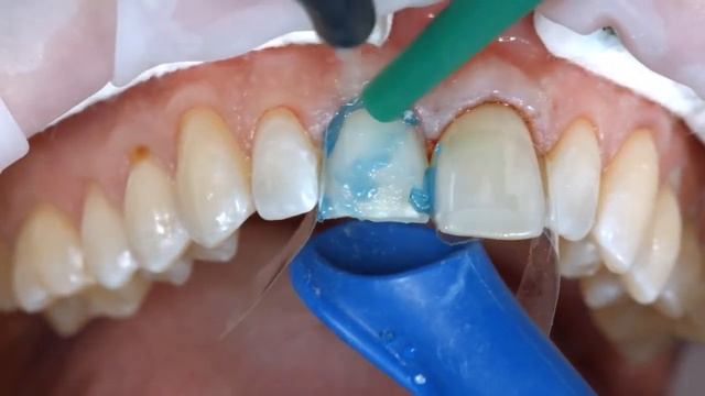 Vitalticks | How to use Ivoclar Vivadent Variolink N LC смотреть онлайн