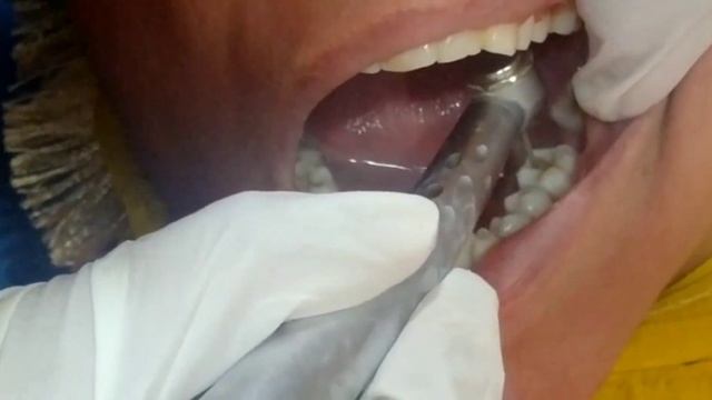 GIC restoration in class 1 cavity... смотреть онлайн