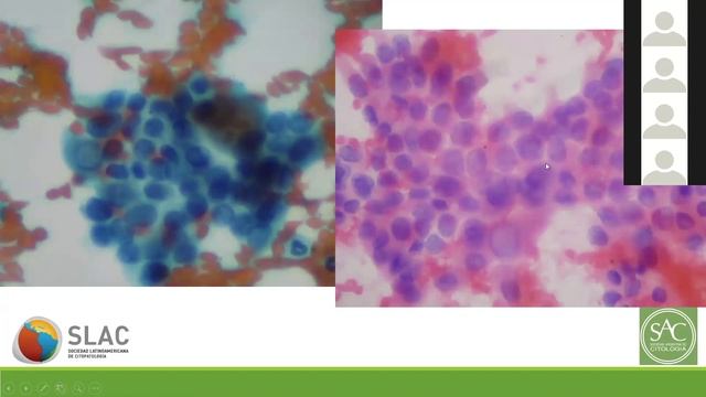 DRA. ANA JAEN, BAAF RETOS DIAGNÓSTICOS. XX ANIV. FEDPATMEX смотреть онлайн