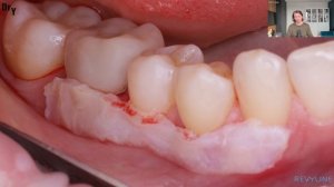 Хирургическое закрытие рецессий десны с разрывом десневого сосочка