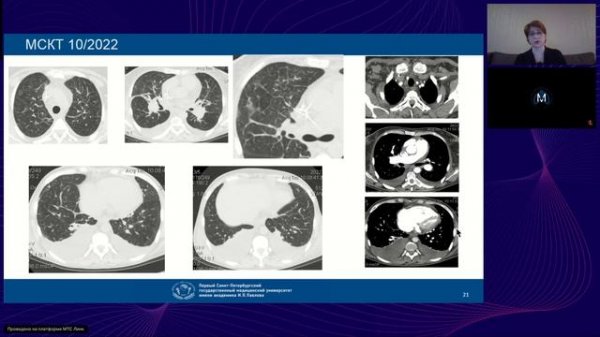 Ретикулярные изменения и изменения в бронхах