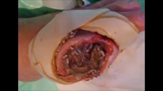 【閲覧注意】寄生虫ウジ虫が人間の壊死を食い止める！注目のマゴットセラピー смотреть онлайн