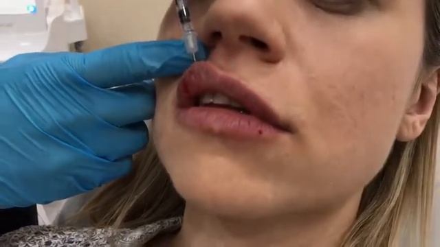 Lip Filler Treatment at Canada MedLaser Clinics смотреть онлайн
