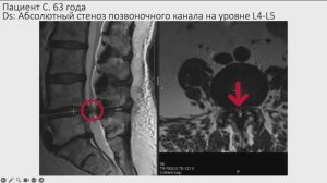 Стеноз позвоночного канала - почему его часто пропускают врачи?